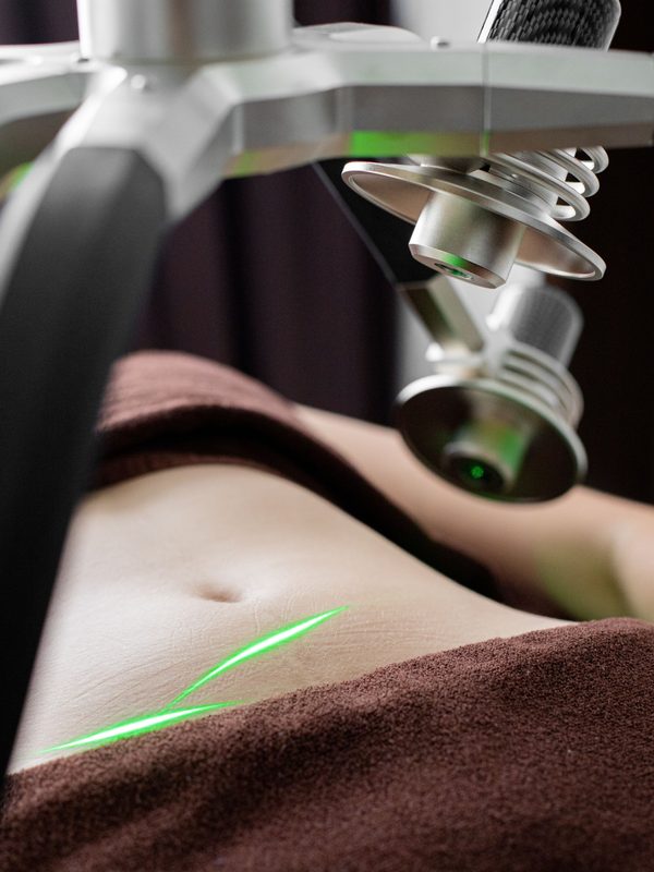 Laser Hair Removal
